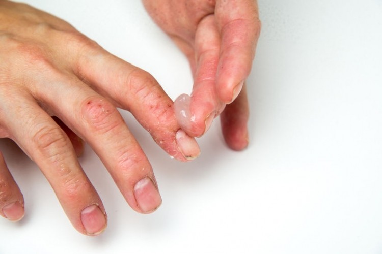 Disidrosi alle dita delle mani e dei piedi ecco la cura