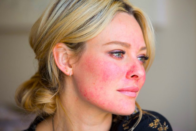 Acne Rosacea: i migliori rimedi naturali