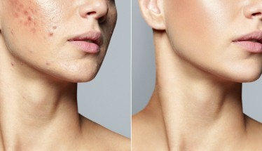 Acido salicilico: esfoliante profondo