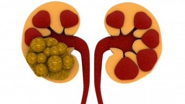 Il sesso cura i calcoli 