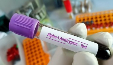 Alfa 1 antitripsina umana: Farmaco, Terapia e Benefici