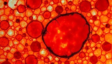 Acido Aminolevulinico (ALA): Rivoluzione nella Terapia Fotodinamica e Oltre