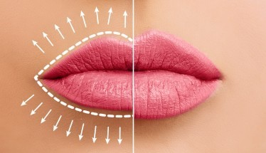 Labbra voluminose: il potere delle vitamine per le labbra