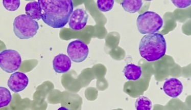 Aldesleuchina: L'Interleuchina-2 al Servizio dell'Immunoterapia