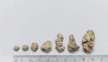 Eliminare i calcoli renali in modo naturale: è possibile?