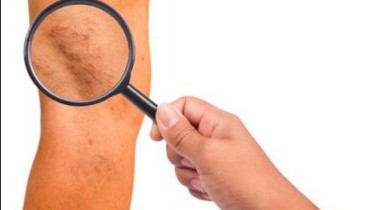 Vene: è il momento migliore per curarsi