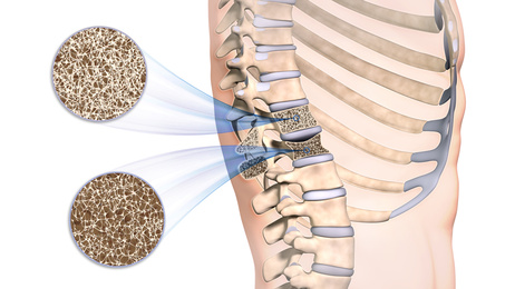 Curare l’osteoporosi con rimedi naturali