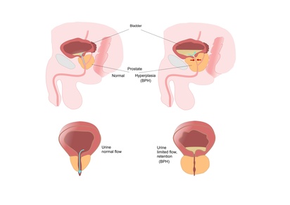 Prostatite: il ruolo dello zinco