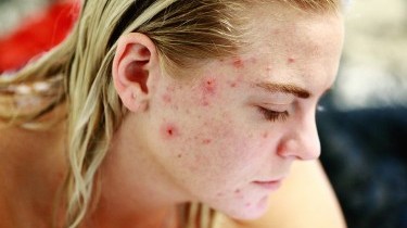 Come curare l'acne giovanile: i nostri consigli