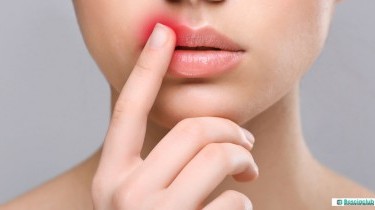 Herpes labiale: i rimedi naturali