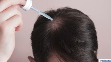 Minoxidil e alopecia: funziona?