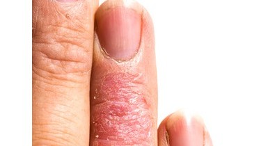 Dermatite atopica: prevenzione, cura e farmaci