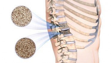 Curare l’osteoporosi con rimedi naturali