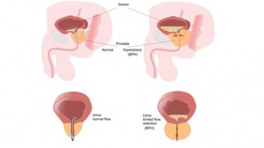 Prostata: liquido amniotico e sesso